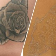 Tattoo Removal from Madison Spa in Nantwich