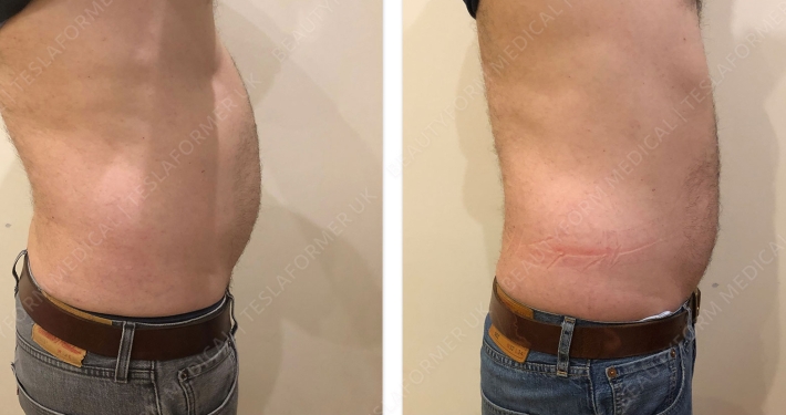 Ultimate Body Sculpting from Renew Clinic in Cheshire